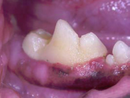 Dental Disease
