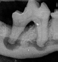 Dental disease below gumline