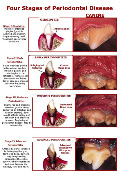 four-stages-of-periodontal-disease