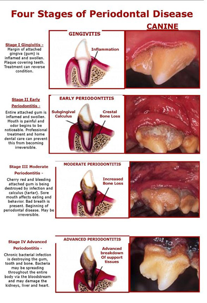 four-stages-of-periodontal-disease